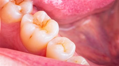 cavities on teeth.